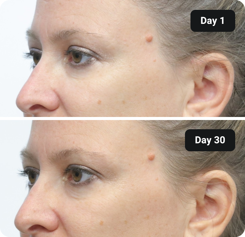 Collagen before and after results